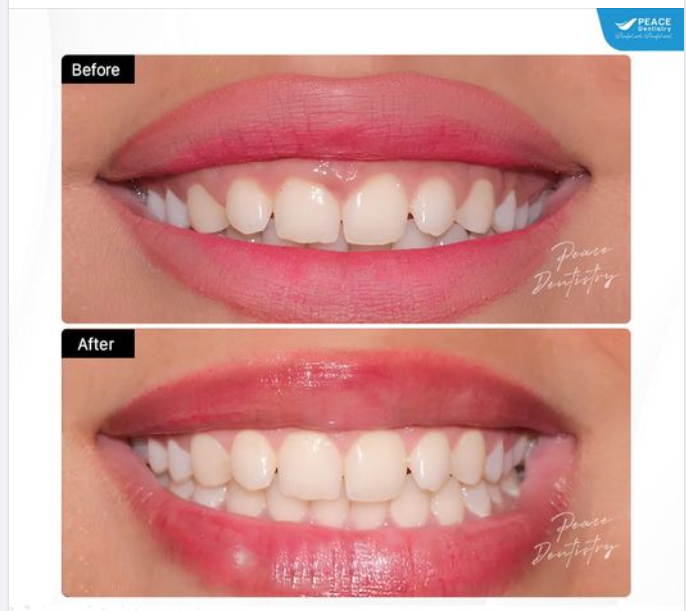 SAU ĐIỀU TRỊ CƯỜI HỞ LỢI CÓ KHẢ NĂNG TÁI PHÁT TRỞ LẠI KHÔNG?