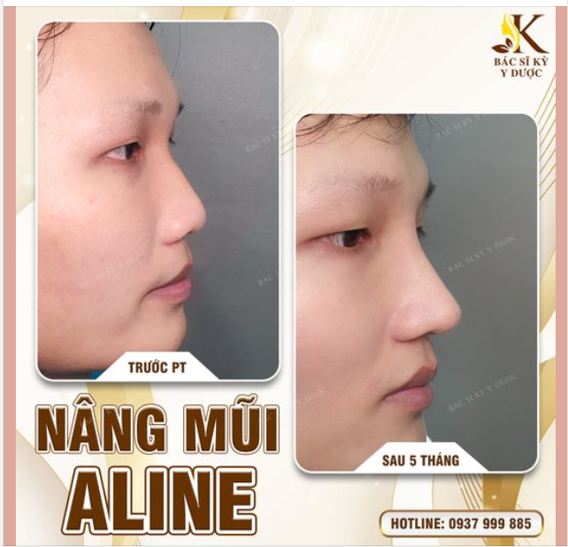 Kết quả dáng mũi 5 tháng tuổi cho bạn khách 2k