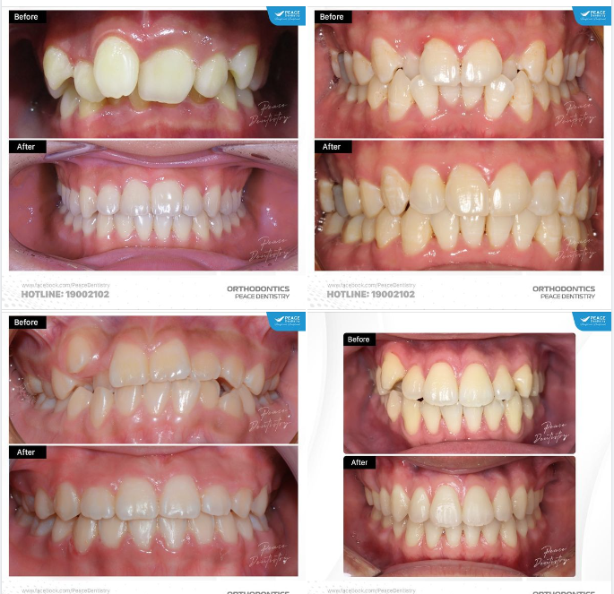 RĂNG KHẤP KHỂNH, CHEN CHÚC - Một số lưu ý quan trọng từ Peace Dentistry!