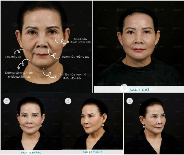 KẾT QUẢ SAU 1,5 THÁNG THỰC HIỆN T.IÊM 16CC FILLER MD CODES KẾT HỢP PROFHILO