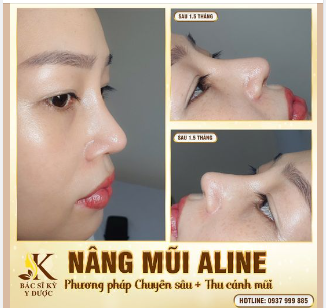 ĐỪNG BUỒN VÌ MŨI KÉM XINH, BỞI TẤT CẢ ĐÃ CÓ BÁC SĨ KỲ Y DƯỢC LO