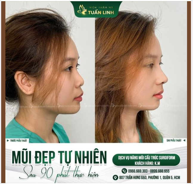 NHAN SẮC THĂNG HẠNG - DÁNG MŨI SANG CHẢNH, ĐẸP TỰ NHIÊN SAU NÂNG MŨI TẠI TUẤN LINH!