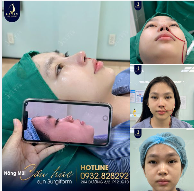 Flex mũi mới cho em gái đến từ Cần Thơ