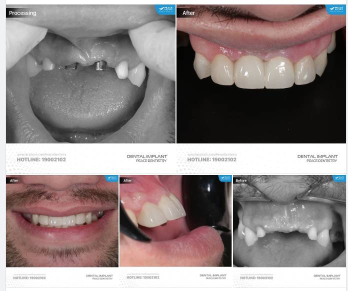 CA LÂM SÀNG IMPLANT VÙNG RĂNG CỬA CÓ GHÉP XƯƠNG, GHÉP NƯỚU | THAY THẾ CẦU RĂNG SỨ CŨ