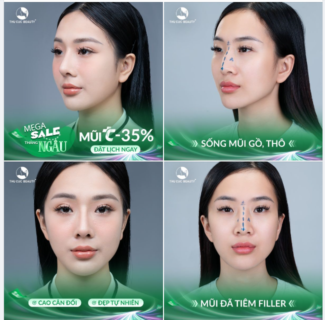 (Góc thắc mắc) Sửa mũi đã tiêm filler có khó không?