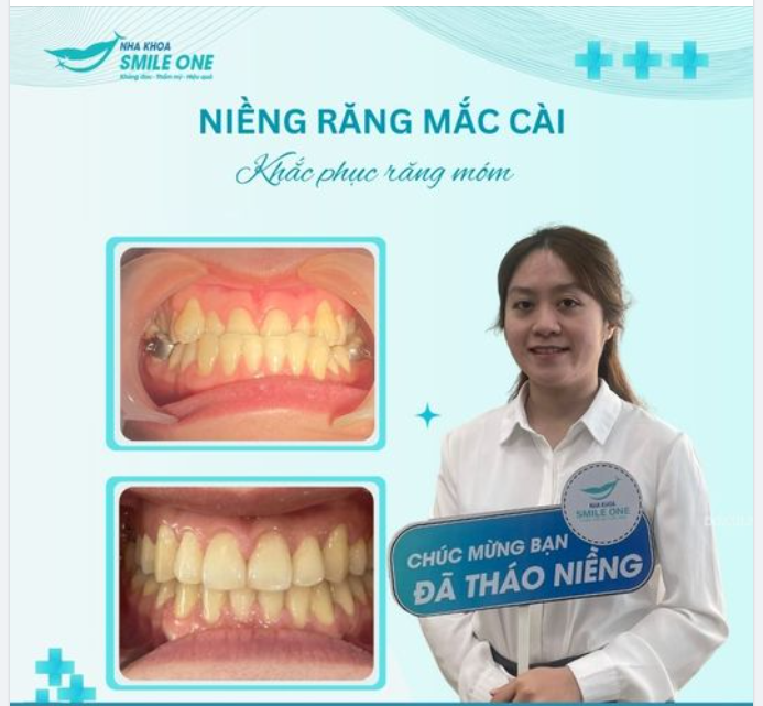 Chúc mừng bạn Thùy Trang đã tháo niềng thành công!