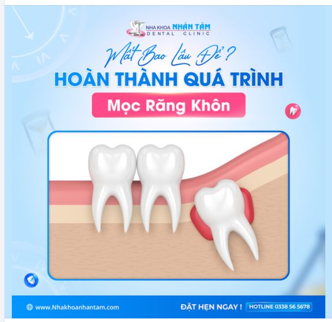 Mất Bao Lâu Để Hoàn Thành Quá Trình Mọc Răng Khôn?