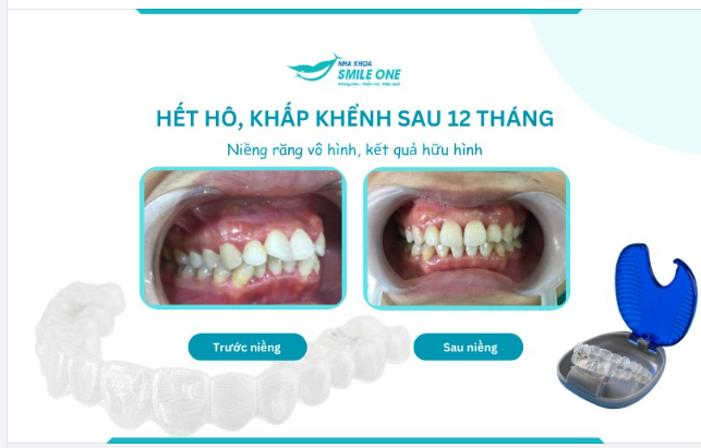 Nếu bạn là một người hướng nội nhưng muốn niềng răng, thì niềng khay trong suốt sinh ra chính là dành cho bạn!