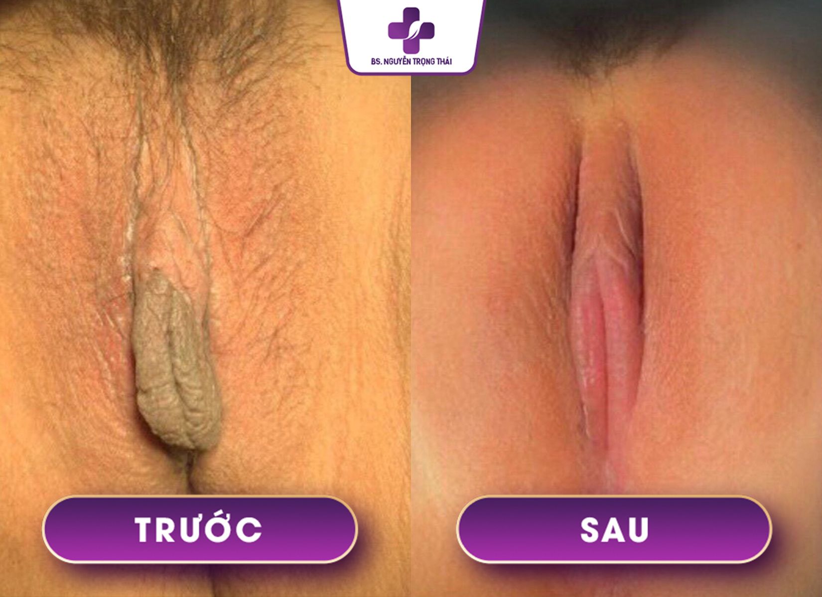 Ảnh B-A Cô bé của BS Nguyễn Trọng Thái