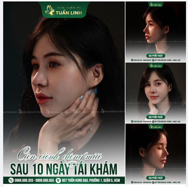 CẬN CẢNH DÁNG MŨI SAU 10 NGÀY TÁI KHÁM TẠI TUẤN LINH - ĐẸP XUẤT SẮC!!