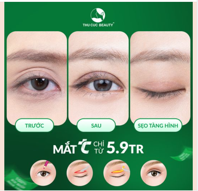  HN Muốn Cắt mí đẹp thì tới đâu ? Tới Thu Cúc Đẹp ngay chỉ sau 15P