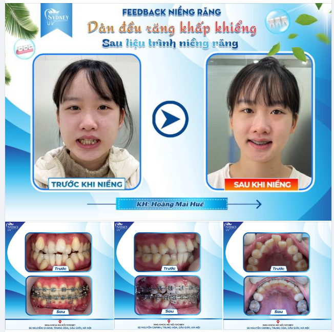 DÀN ĐỀU RĂNG KHẤP KHỂNH SAU LIỆU TRÌNH NIỀNG RĂNG