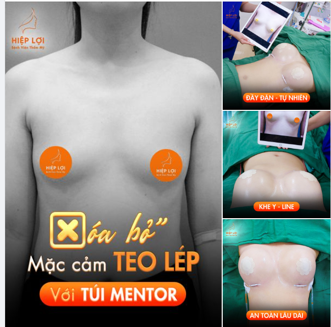 Ngực đẹp gợi cảm - Chỉ với 90 phút
