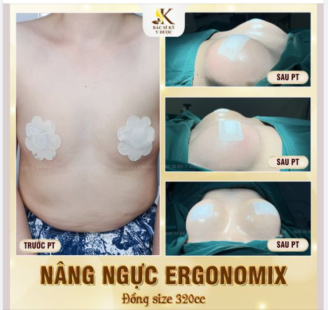 “GIẢI CỨU” VÒNG 1 NHỎ, LÉP, KHÔNG ĐỀU