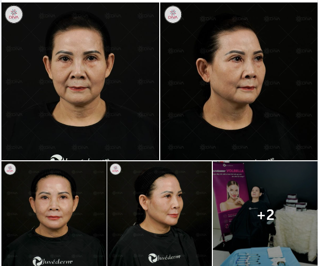 TIÊM FILLER MD CODES ĐÚNG KỸ THUẬT THÌ DÙ DÙNG TỚI 16CC VẪN KHÔNG GÂY VÓN CỤC, NẶNG NỀ KHUÔN MẶT