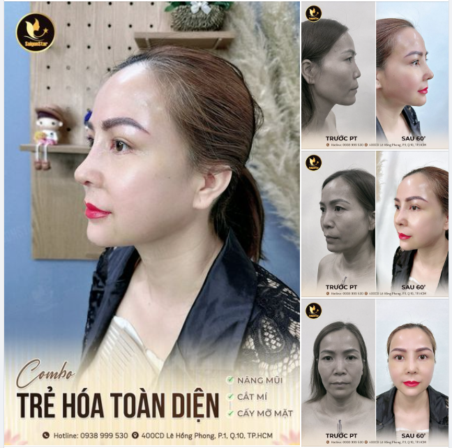 Chị Mỹ Quý (Việt kiều Mỹ) thành công sở hữu diện mạo trẻ đẹp sau 10 ngày thực hiện combo: