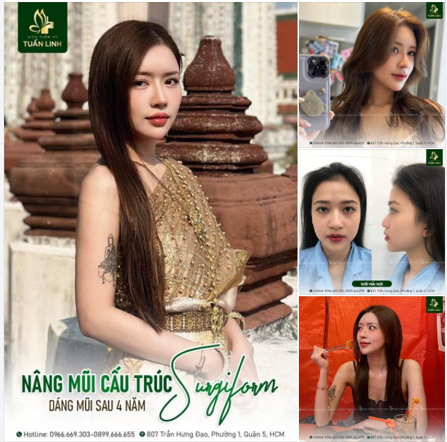 NÂNG MŨI CẤU TRÚC SURGIFORM - DÁNG MŨI SAU 4 NĂM- ĐẸP XUẤT SẮC!!