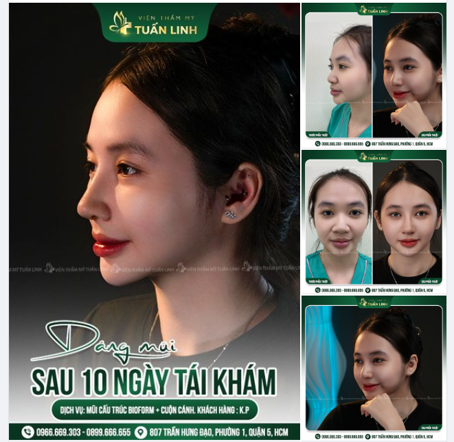 Bạn sẽ không biết mình có thể thay đổi và xinh đẹp hơn nhiều như thế nào...cho đến khi bạn nâng mũi!!