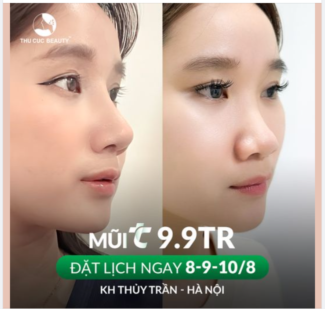 Nâng mũi giá gốc, tin được không?