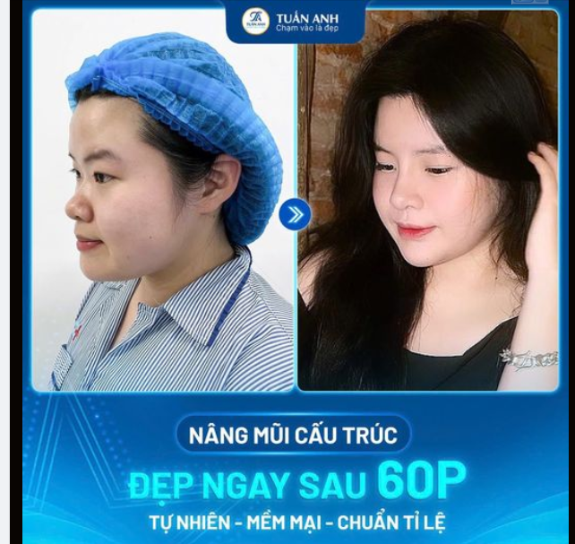 DÁNG MŨI THANH TÚ - THĂNG HẠNG NHAN SẮC
