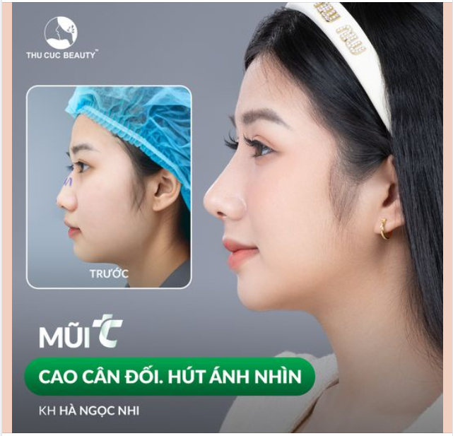 Cảm nhận khác biệt sau 30P thực hiện nâng mũi tại Thu Cúc