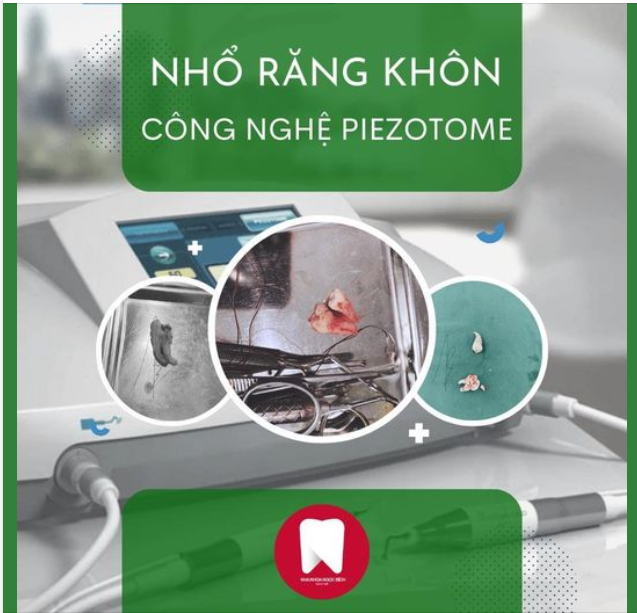 NHỔ RĂNG KHÔN KHÔNG ĐAU VỚI PIEZOTOME