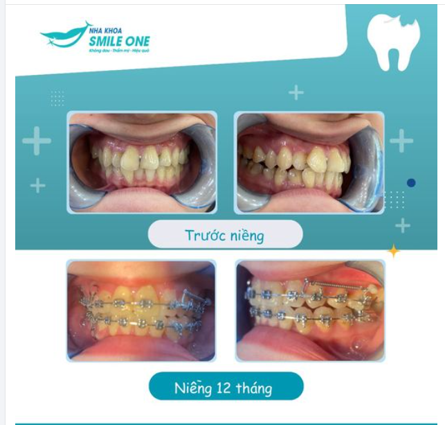 Niềng răng sớm, rạng rỡ nụ cười, sáng ngời tương lại!