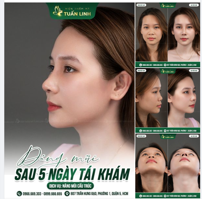 Dáng mũi nhà Tuấn Linh sau 5 ngày tái khám có gì nổi bật??