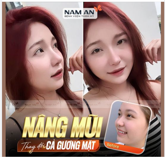 NÂNG MŨI THAY ĐỔI CẢ KHUÔN MẶT