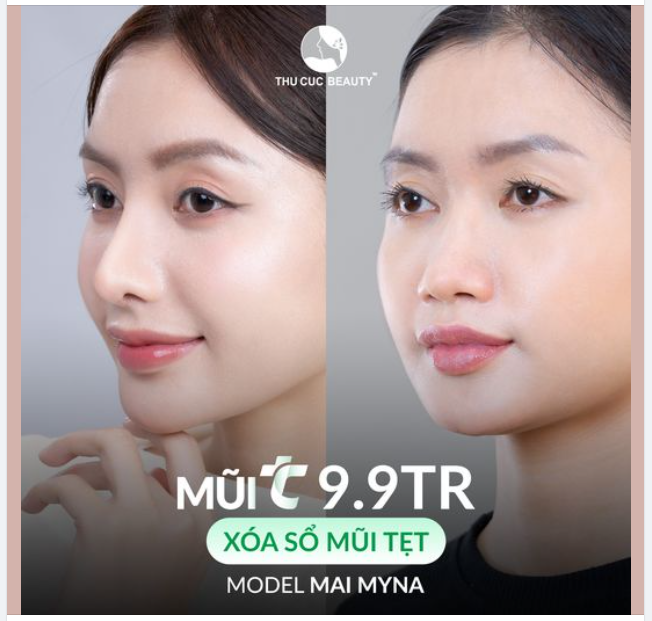 Sở hữu dáng mũi tự nhiên, thanh thoát với chi phí siêu hời