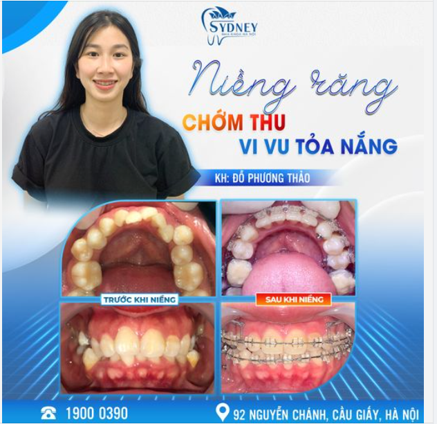 NIỀNG RĂNG CHỚM THU - VI VU TỎA NẮNG