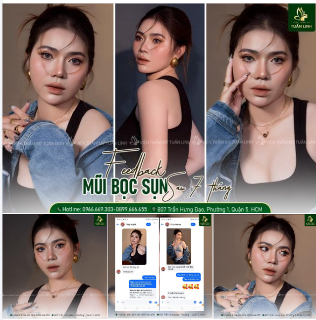 Feedback Nâng mũi bọc sụn sau 7 tháng của bạn khách vô cùng đáng yêu!!