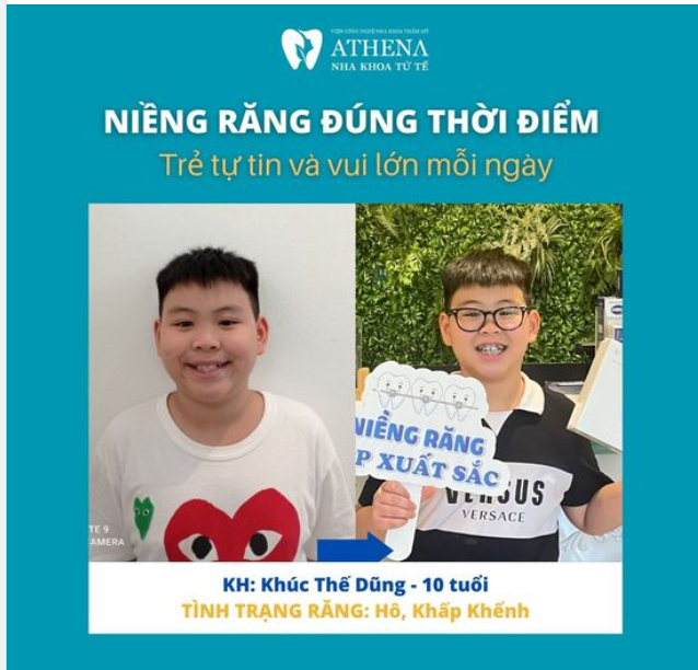 NIỀNG RĂNG SỚM: RẠNG NGỜI CON YÊU, BỪNG SÁNG TỰ TIN!