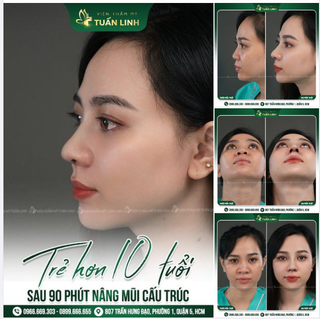 Trẻ ra 10 tuổi sau 90 phút nâng mũi cấu trúc!!