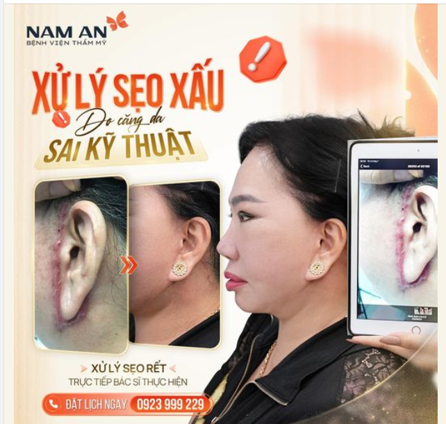 SẸO XẤU lấy da cắt đi 100% sẽ lồi trở lại