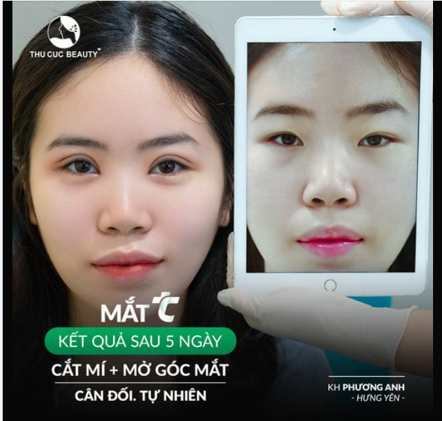 Đi từ Hưng Yên ra Hà Nội để Cắt mí + Mở góc mắt  KH Phương Anh đã thay đổi như thế nào?