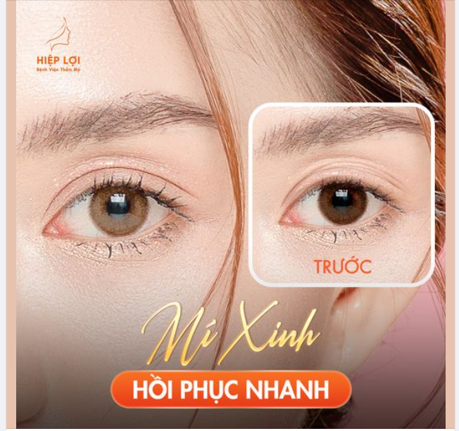 Bạn bị "đa nếp mí" khiến đôi mắt trông thiếu sức sống?