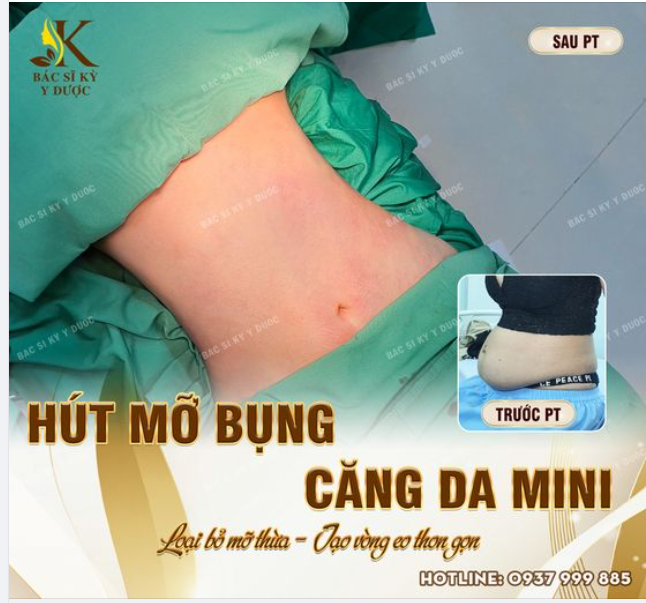HÚT MỠ BỤNG + CĂNG DA MINI - TẠO VÒNG EO HOÀN HẢO