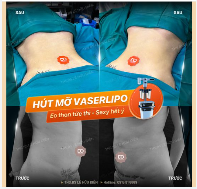 HÚT MỠ VASERLIPO EO THON TỨC THÌ, SEXY HẾT Ý.
