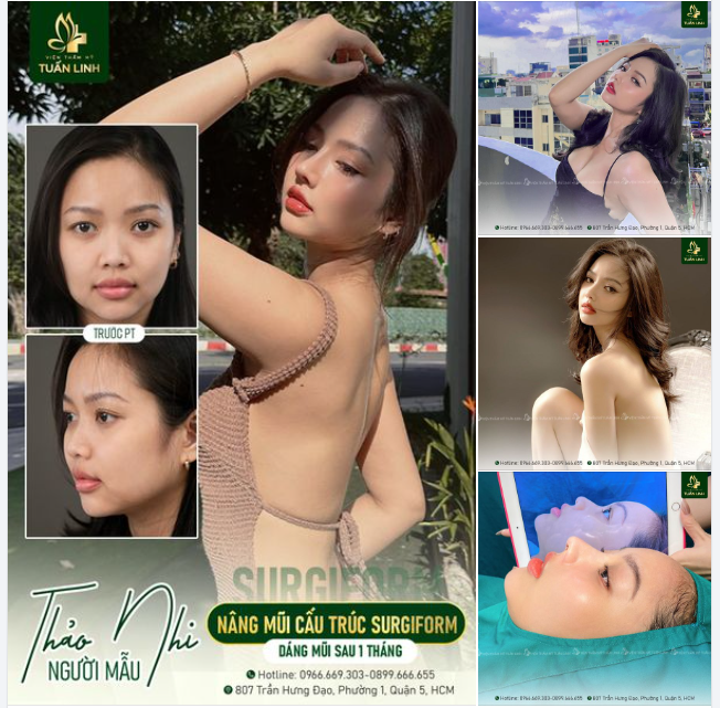 Người mẫu Thảo Nhi với thần thái "miễn bàn" cùng dáng mũi Angel line cao sang sau 1 tháng nâng mũi!!