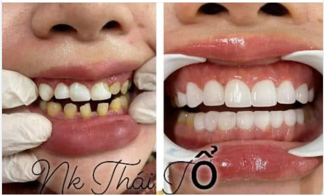 BỌC RĂNG SỨ - GIẢI PHÁP TỐI ƯU CHO RĂNG SỨT MẺ, GÃY VỠ