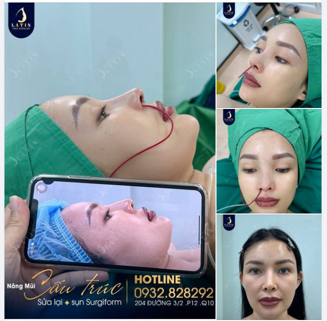 Hoàn thành ca sửa mũi cho chị gái đến từ Nha Trang