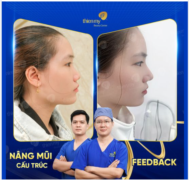 Nâng mũi cấu trúc ưu điểm vượt trội. Cao bay, khác biệt, hoàn hảo