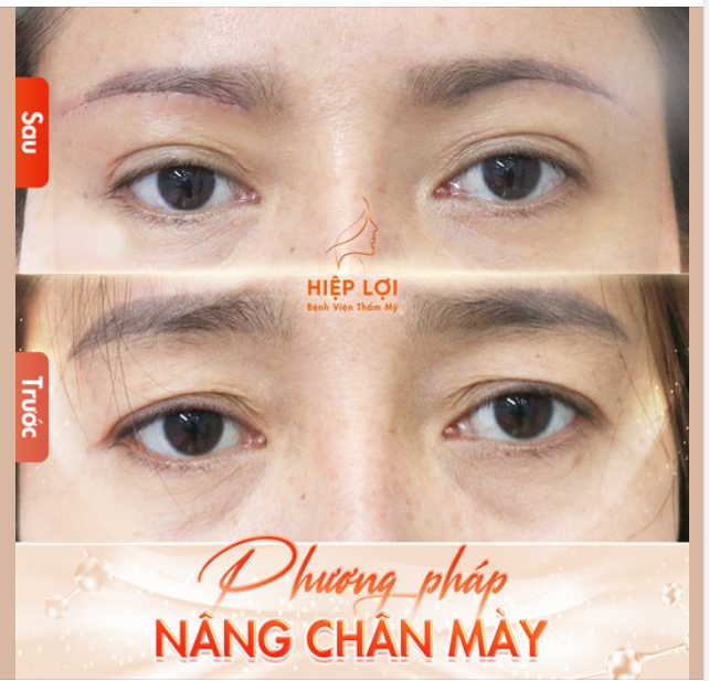Thẩm mỹ nâng chân mày là gì?