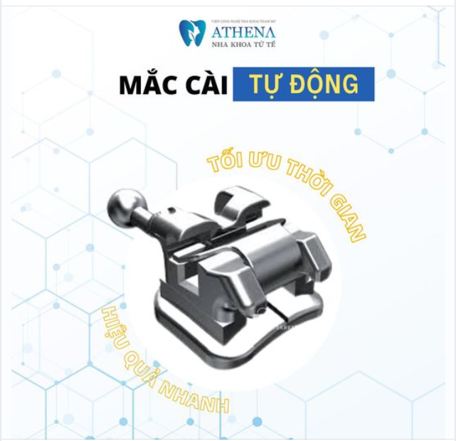 Niềng răng nhanh chóng và hiệu quả với mắc cài tự động 