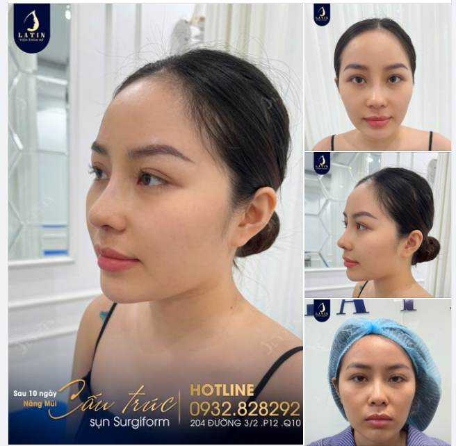 Chị gái đến Latin nâng mũi theo lời giới thiệu của người thân và cái kết mãn nguyện.