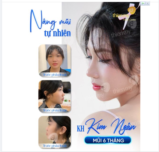 Chỉ sau 6 tháng, Chị Kim Ngân đã lột xác với chiếc mũi mới thanh tú và tự nhiên.