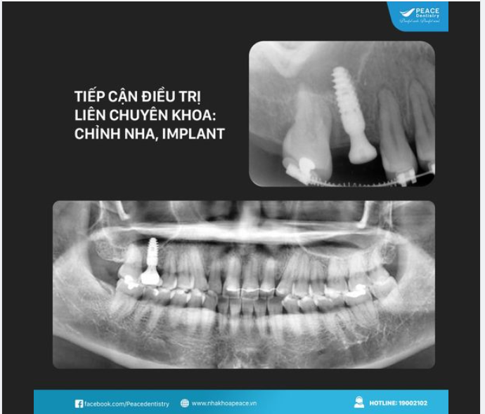 Mất răng nhiều năm, tiêu xương dẫn đến di chuyển, nghiêng răng kế cận và tiếp cận điều trị liên chuyên khoa: chỉnh nha tạo khoảng để cấy ghép implant.