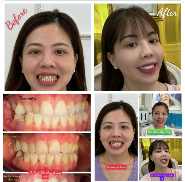 Combor: Niềng răng - phục hình răng sứ thẩm mỹ & cấy ghép Implant của TEAM NHA KHOA PHƯƠNG ANH