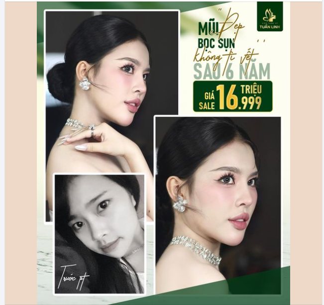 Nâng mũi Sline bọc sụn tai - Mũi siêu đẹp - Giá siêu yêu!!